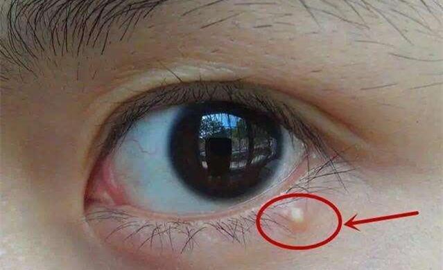 眼睑皮脂腺图片