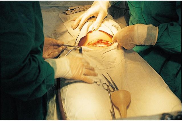 图解女人剖腹产手术全过程,胆小者勿入