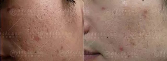 种下的痘，留下的坑，痘坑，我该拿你怎么办？