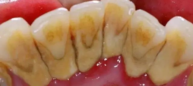 你还在用手扣牙洁石吗?能扣掉吗?