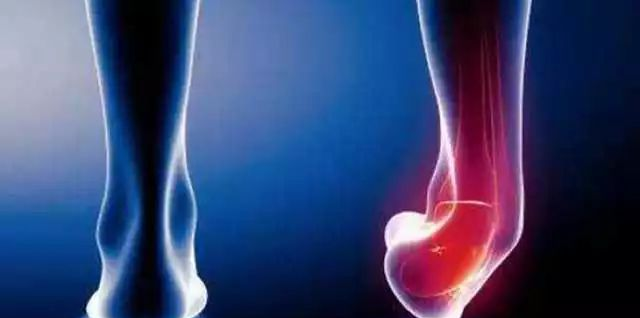 年轻女孩崴脚后12天离世,崴个脚真的这么可怕