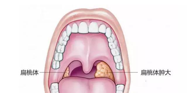 腺样和扁桃体肥大有什么
