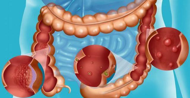 常见3种大肠息肉症状
