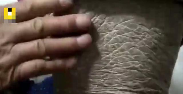 太让人心疼了!4岁女童浑身长鱼鳞,撕掉3天后又长!