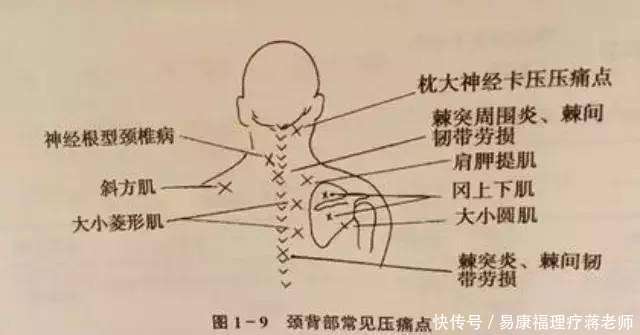 运用中医针灸、刮痧、推拿按摩治疗神经根型颈