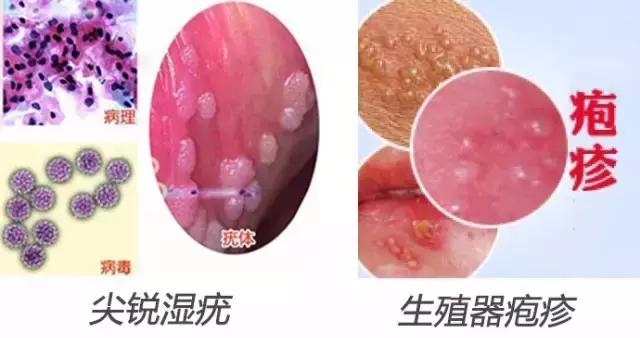 专家教你变火眼金睛分辨真假尖锐湿疣对症治疗安全省钱0复发