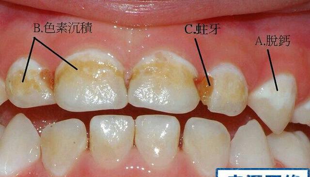 四颗门牙发黄,有色素沉淀.四颗下门牙牙缝发黑,感觉牙垢特别多.