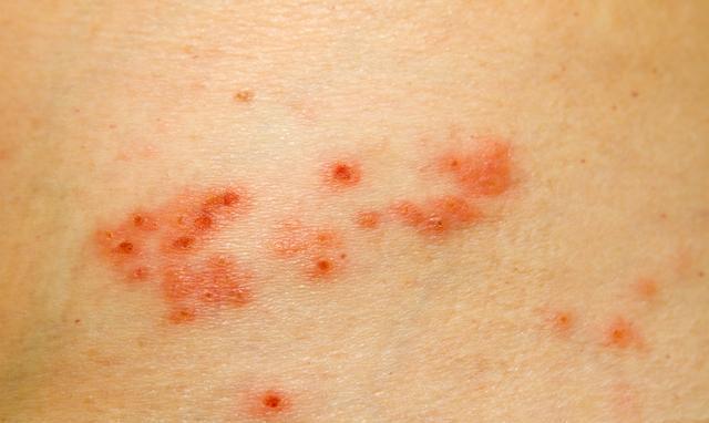 毛囊炎有什么治疗的好方法 ed53-fyrhcqz7025649.jpg