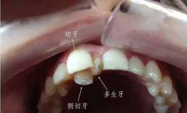 门牙缝大,牙缝大怎么办?门牙中间有间隙看这里