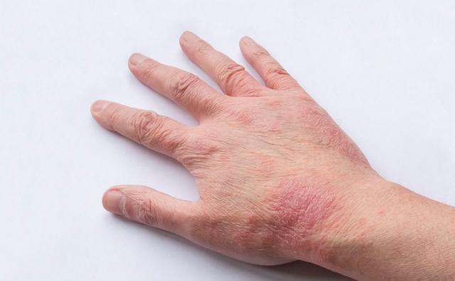 湿疹传染?中医教你用简单一花草,告别常年瘙痒