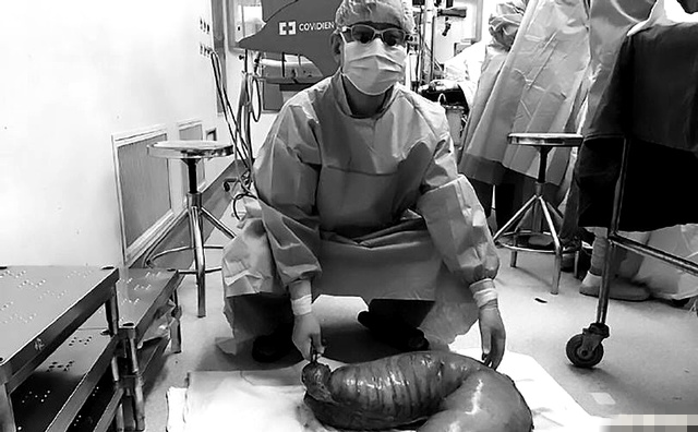 便秘20年的国外男子,实在忍受不了才手术,术后