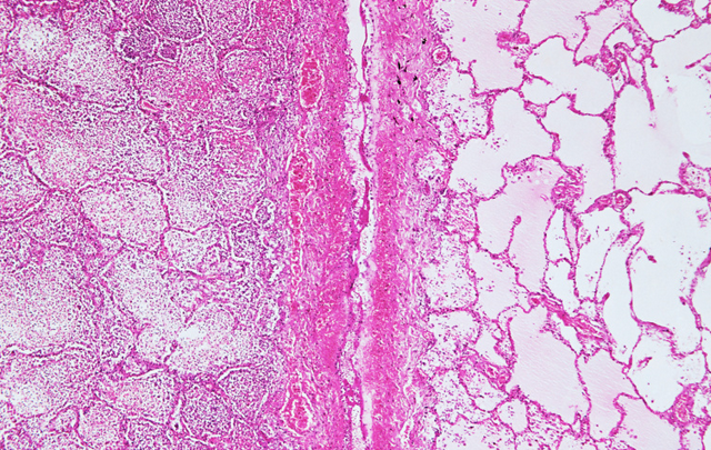 少了一个肾还能活多久?正确答案很可怕
