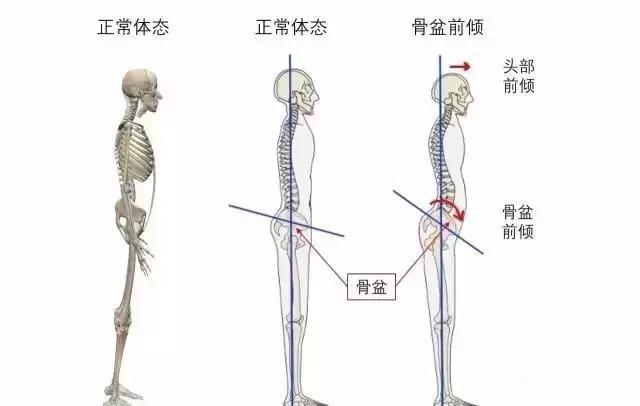 如何鉴别你的翘臀不是骨盆前倾，简直太形象了！