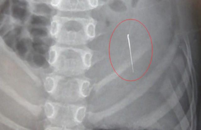 妈妈带孩子去医院补牙,医生中途停下出去,后来