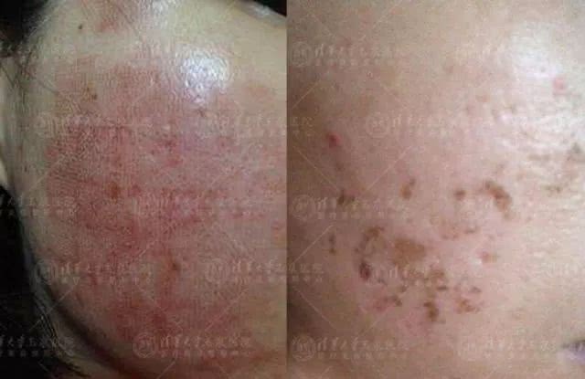 种下的痘，留下的坑，痘坑，我该拿你怎么办？
