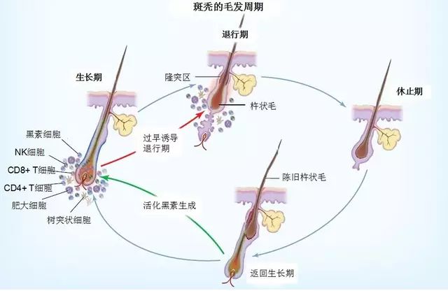 都说鬼剃头是自愈系,为啥我的斑秃久治不愈