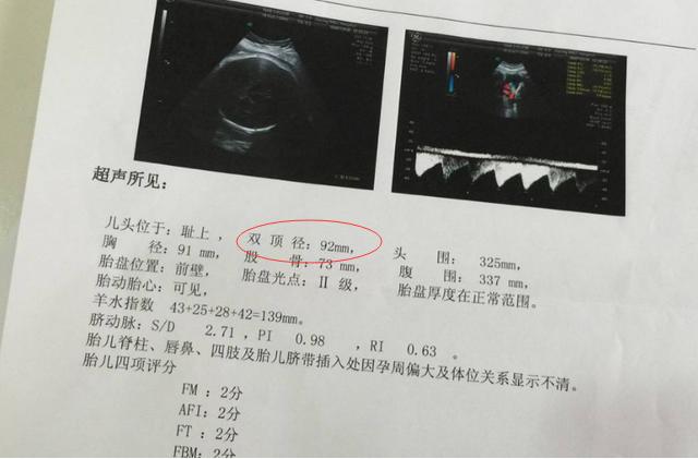 别再问医生胎儿性别了,B超单子上的这4个字