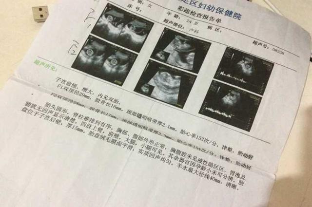 孕早期如果出现这3个反应, 多半怀了双胞胎! 你