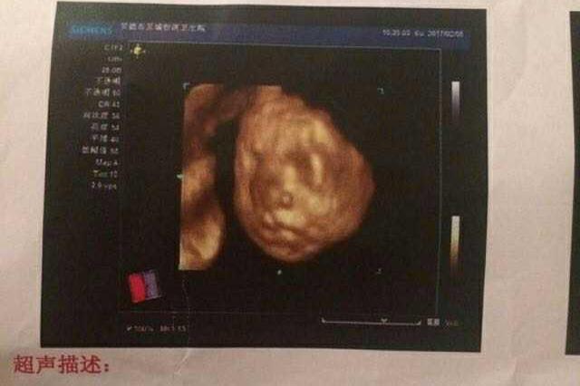 肚脐妊娠线很黑很明显,果真顺产了一个七斤男宝宝
