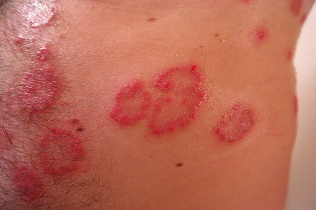 它是一种常见的慢性皮肤病,其特征是皮肤出现大小不等的丘疹和红斑,并