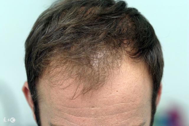 前额头顶头发少怎么办?你们终于有救了!
