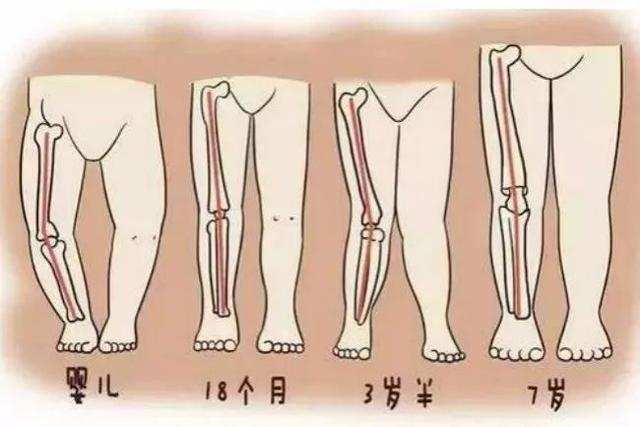 宝宝肋外翻,o型腿,x型腿是缺钙吗?
