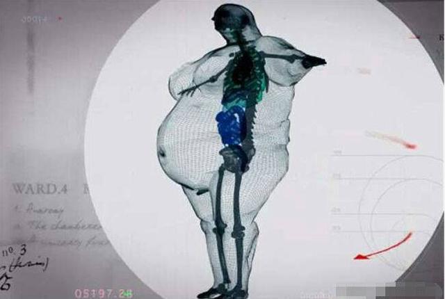 890斤的男子去医院拍x光片,身体骨骼让人害怕,肥胖就会有?