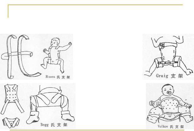 先天性髋关节发育不良保守治疗,手术治疗方案