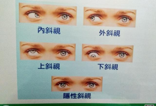 上,下斜视眼位向上或向下偏斜,比内斜视和外斜视少见,上下斜视常伴有