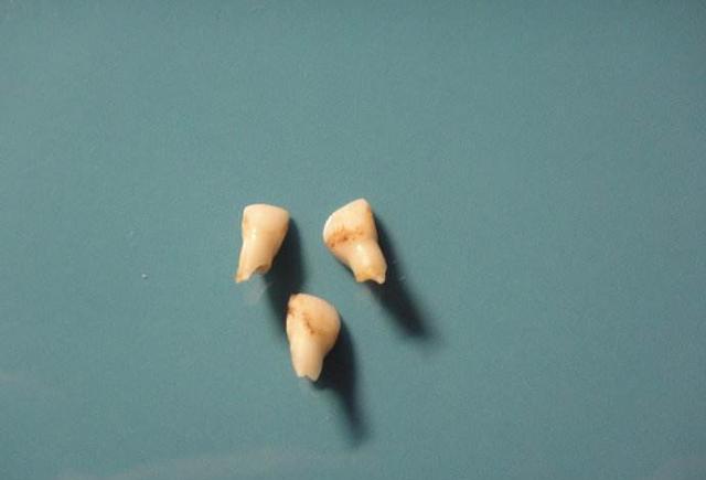 牙根不完整脱落了,你会担心乳牙根断在骨头里吗?