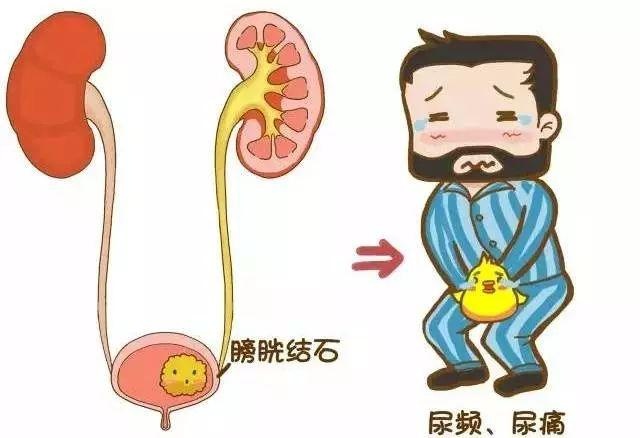 正文    诱发尿路感染   对于尿道结石这种疾病来说,不及时治疗会引起