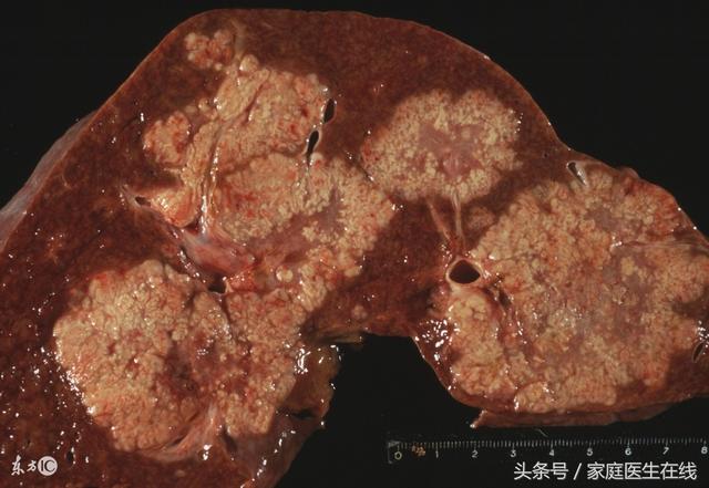 大家要认准了:这6个异常是早期肝癌的症状!越早知道对