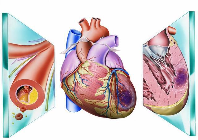 心肌梗塞五症状给你敲警钟