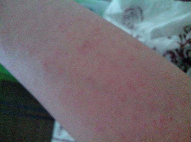 冬天在身上长了很多小红点是怎么回事?