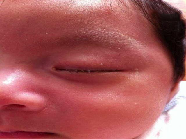 2岁男孩玩沙子后双眼永久失明,医生竟在眼睛里