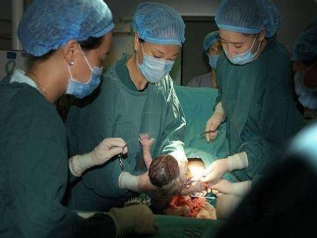 43岁高龄孕妇怀二胎,孕7月剖腹产,打开肚子瞬