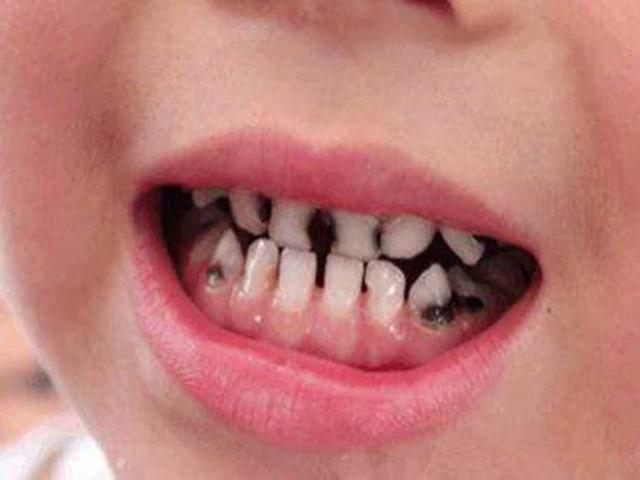 8岁孩子患上牙龈癌晚期, 满嘴都是烂牙, 只因吃了这些