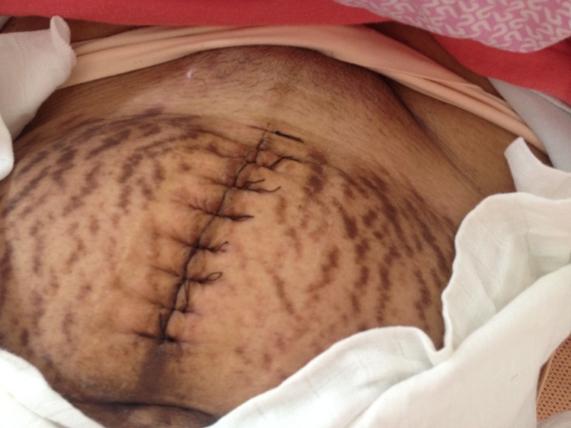 我26岁,去年做过剖腹产,最近躺在床上睡觉咳嗽打喷嚏肚子跟抽筋一样痛,一下就好了,还有不知道怎么回