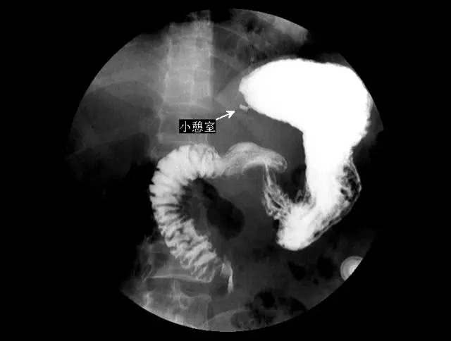 5 分钟读懂消化道造影片