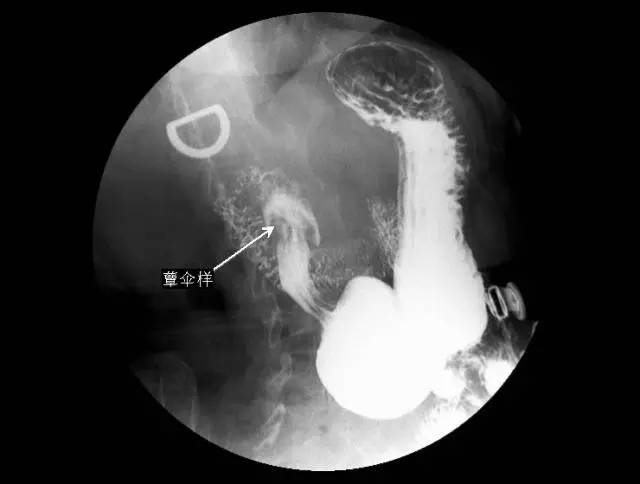 5 分钟读懂消化道造影片