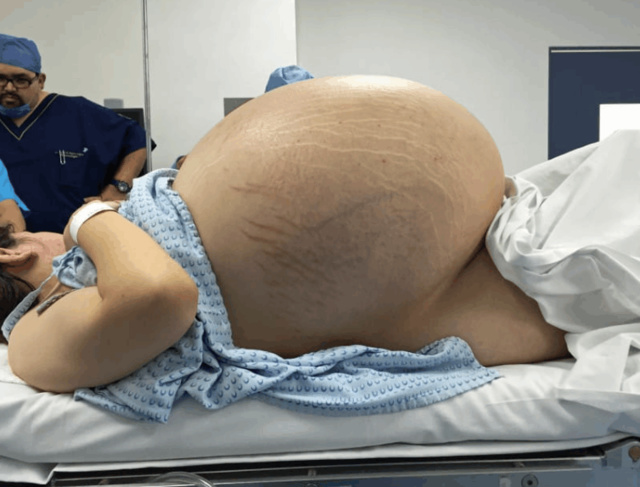 女子肚子大如巨球,以为怀孕,b超显示空无一物!惊现"