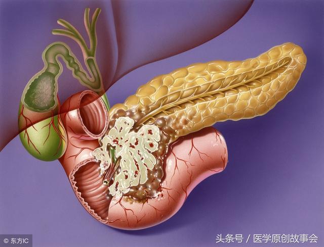 可能也难以发现,等到发现时往往已经处于中晚期,而且肿瘤恶性程度高