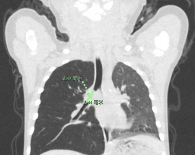 16 月大婴儿猛咳!一查竟有开心果堵在支气管