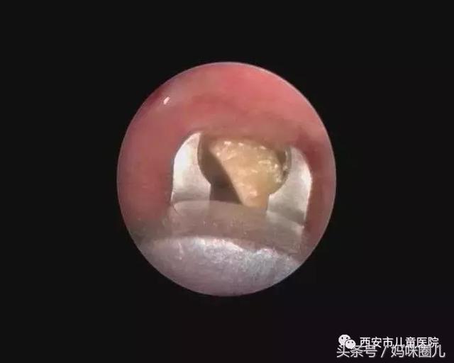 春节西安儿童医院接诊21例气管异物 别给5岁以