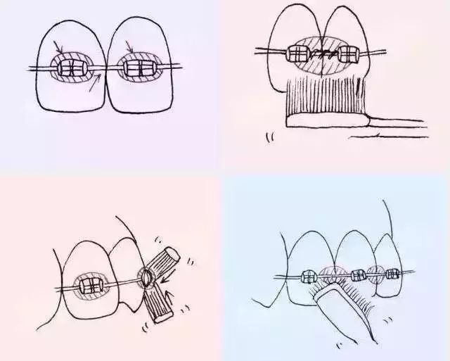 科普_正畸以后该怎么刷牙呢?