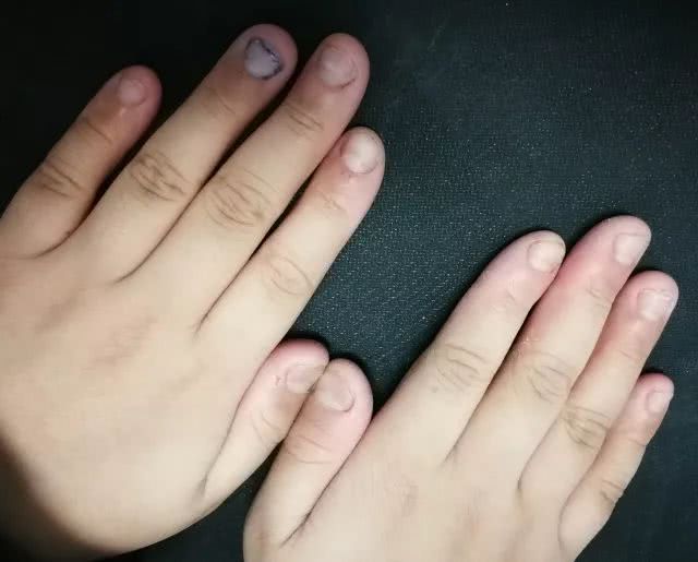 孩子啃指甲到底是谁的问题