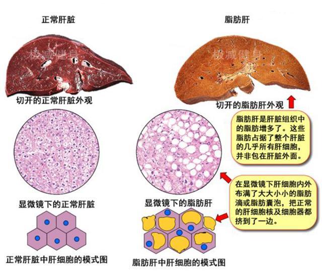根据体质分析或者核磁共振扫描的结果,可以将内脏脂肪分成多个等级