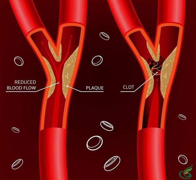 血管堵塞跟什么有关系? 那么心血管堵塞有些什
