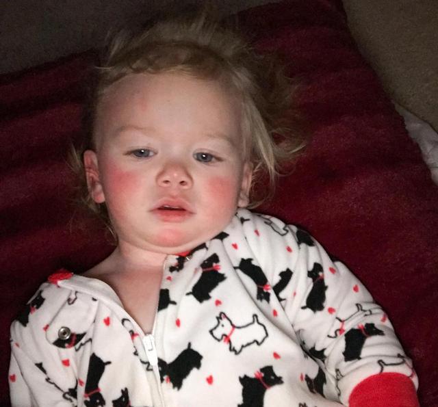 全球仅50例!一岁半女娃对水过敏,泪水汗水都不