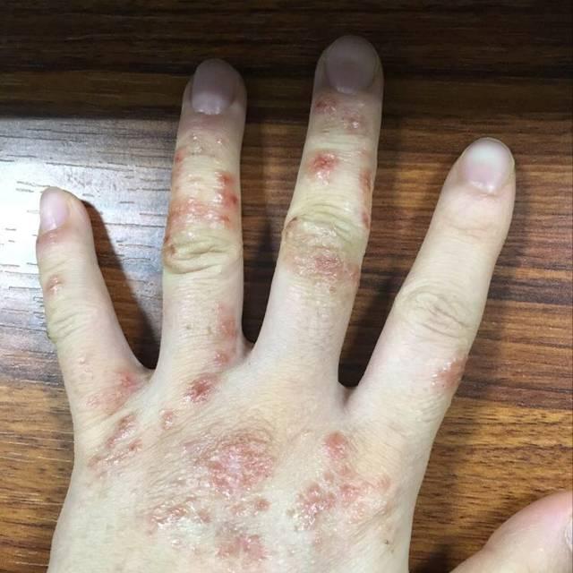 湿疹|湿毒|手部